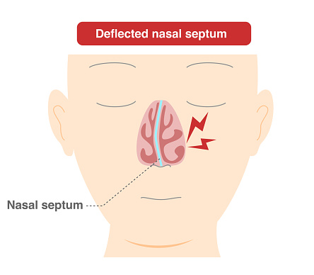 Illustration of nasal diaphragm curvature caused by deformation of the nasal diaphragm