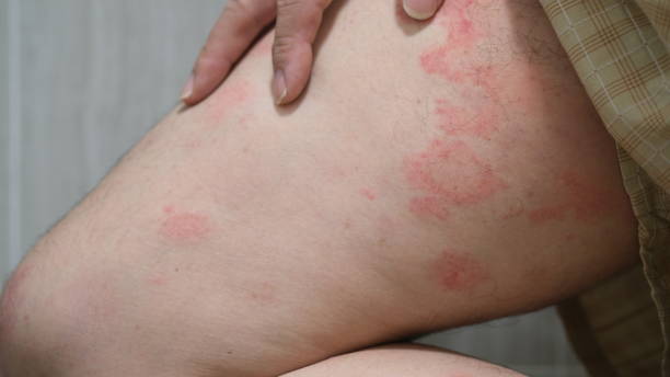 istock Allergy hives or kaligata on a man's thighs. 2149193532