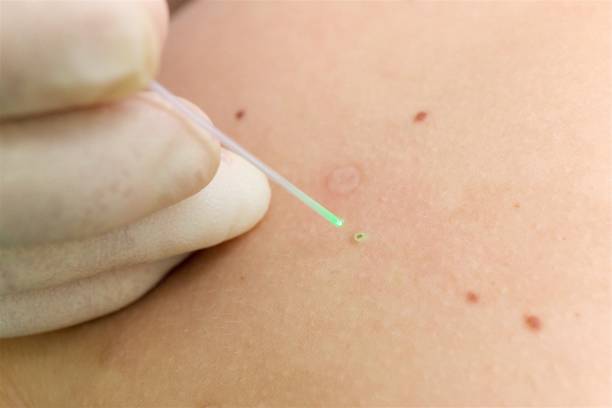 istock Laser removal procedure of a skin lesion, mole: hand in a glove with a laser pointer. 2149254232