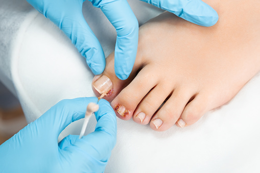 Close up podiatrist examines the nail and applies an antifungal treatment.