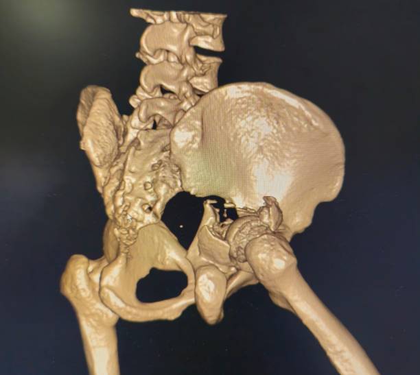istock Acetabular Fracture 3D Ct Scan 2149400998