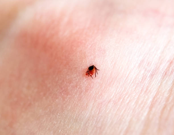 istock A tick embedded in a person skin. 2149413201