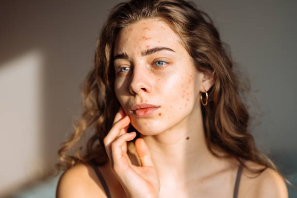 istock Pimples and acne on the woman's face. 2149414692