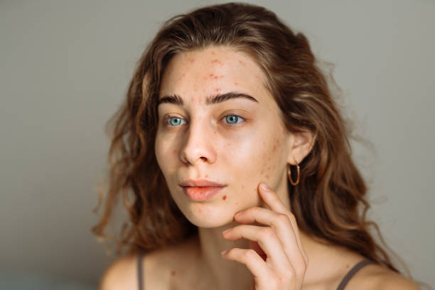 istock Pimples and acne on the woman's face. 2149414695