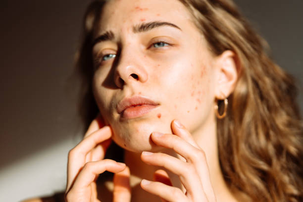 istock Pimples and acne on the woman's face. 2149414696