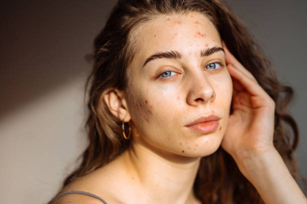 istock Pimples and acne on the woman's face. 2149414697