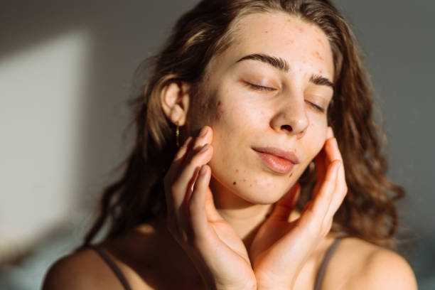istock Pimples and acne on the woman's face. 2149414701