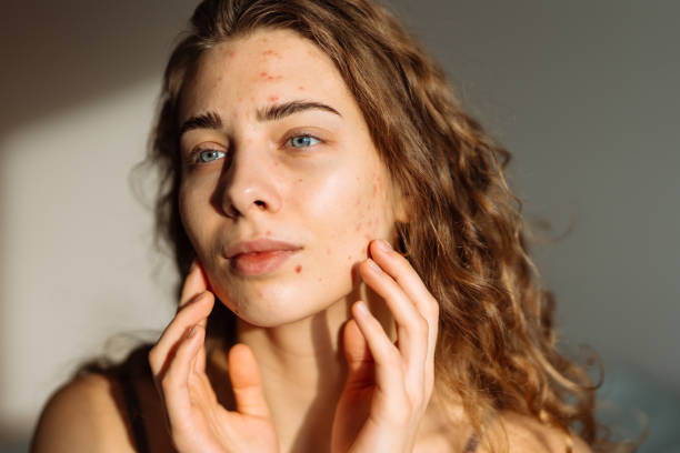 Pimples and acne on the woman's face.