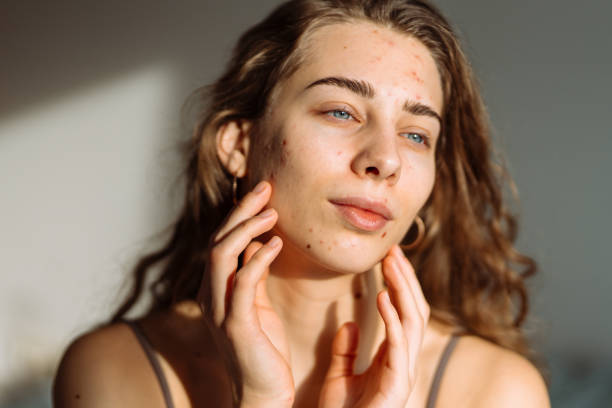 istock Pimples and acne on the woman's face. 2149414709