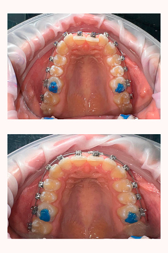 Close-up photo before and after braces are installed.