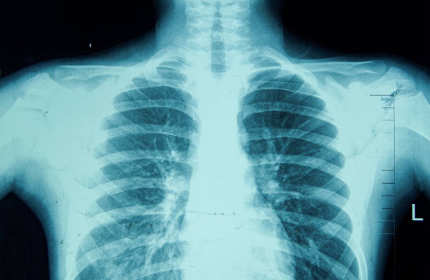 human thoracic cavity x-ray film - sleutelbeen-fotos stockfoto's en -beelden
