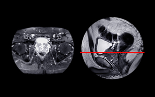 MRI of the prostate gland reveals Focal abnormal SI lesion at left PZpl at apex as described; PI-RADS category 4, clinically
significant cancer is likely.