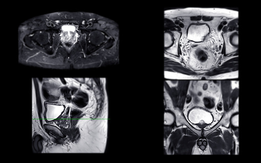 MRI of the prostate gland reveals Focal abnormal SI lesion at left PZpl at apex as described; PI-RADS category 4, clinically
significant cancer is likely.