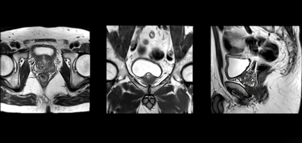 MRI of the prostate gland reveals Focal abnormal SI lesion at left PZpl at apex as described; PI-RADS category 4, clinically\nsignificant cancer is likely.