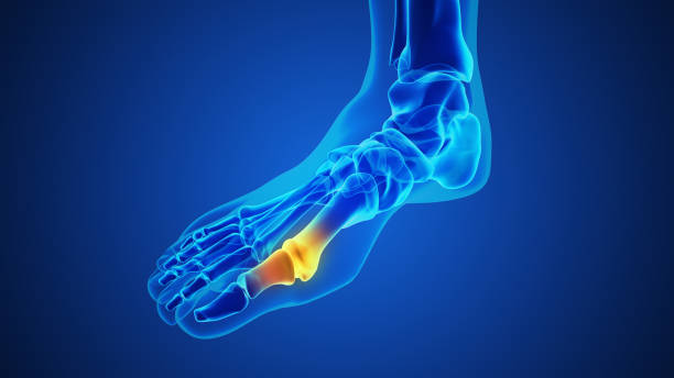 Painful gout inflammation on big toe joint