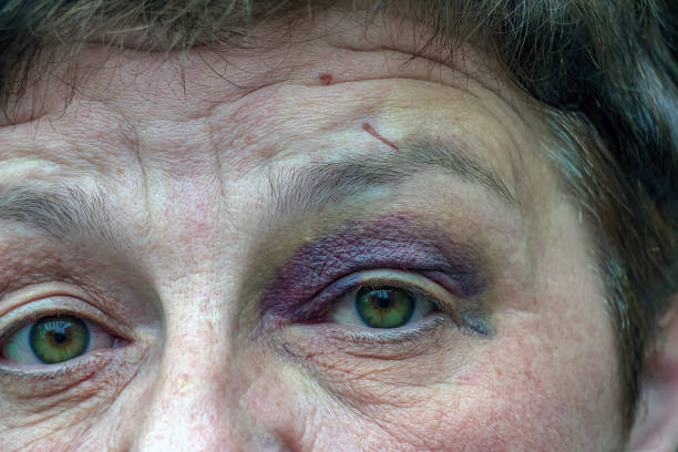 istock A human eye with a large black-violet bruise. Swelling due to bruise 2150172431
