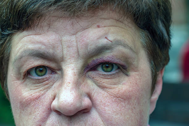 istock A human eye with a large black-violet bruise. Swelling due to bruise 2150172491