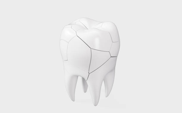 istock Human tooth model, tooth cracking, oral rehabilitation, 3d rendering. 2150230335