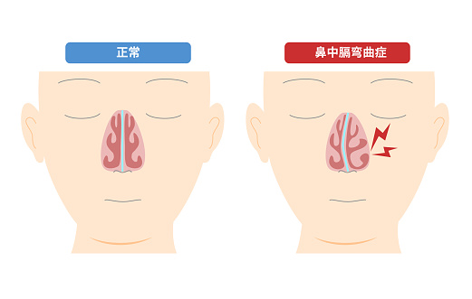 Illustration of nasal diaphragm curvature caused by deformation of the nasal diaphragm
