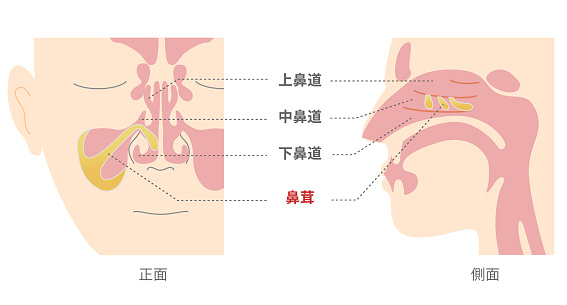 Illustration of nasal polyps in the sinuses from front and side views