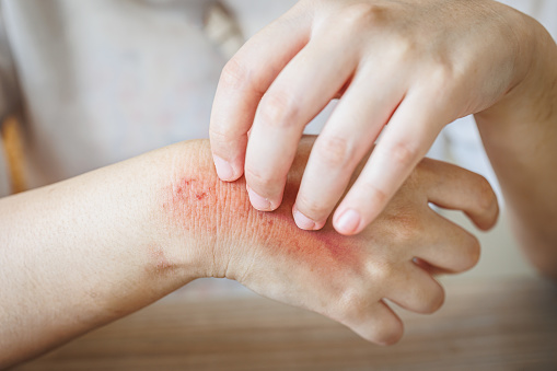 hand itching scratching. Itchy red rash, flea allergies, blister fungal annoying skin diseases