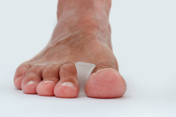 istock Silicone toe separator for bunion toe or hallux valgus. 2150305645