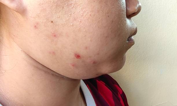 istock The acne and scar on the face. 2150305905