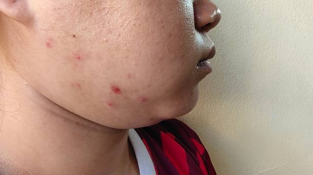 istock The acne and scar on the face. 2150306437