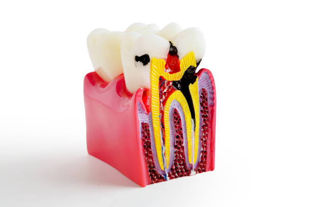 istock Decay tooth replace with dental implant root canal teeth model for education isolated on white background with clipping path. 2150323502