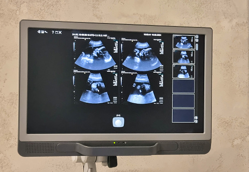 ultrasound monitor with fetus pictures, ultrasound equipment with baby pictures, medical examination of the body of the pregnant woman patient