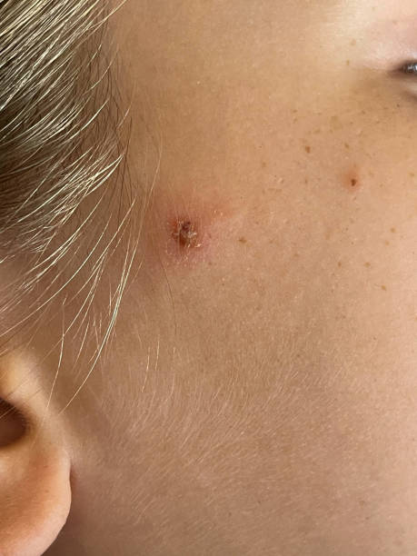 istock Virus or bacterial infection. Scratched pimples on human skin close up. Infectious disease 2150480891