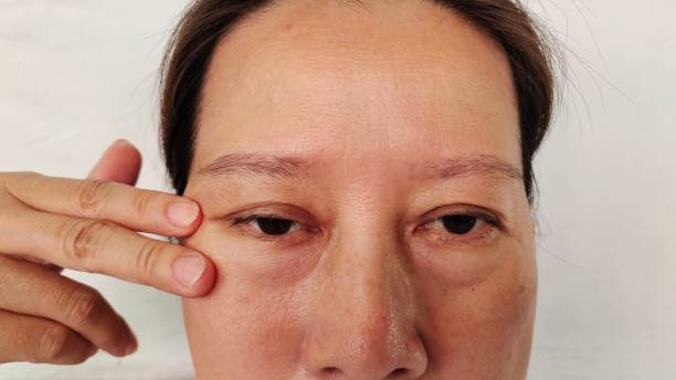 istock Ptosis and swelling on the face. 2150505353
