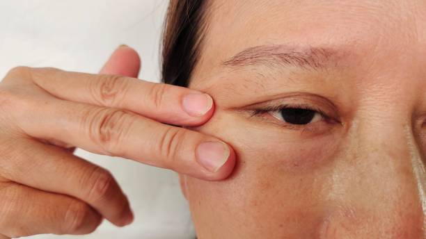istock Ptosis and swelling on the face. 2150505424