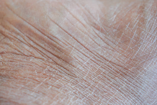 istock Closeup view of dry human skin . 2150565617