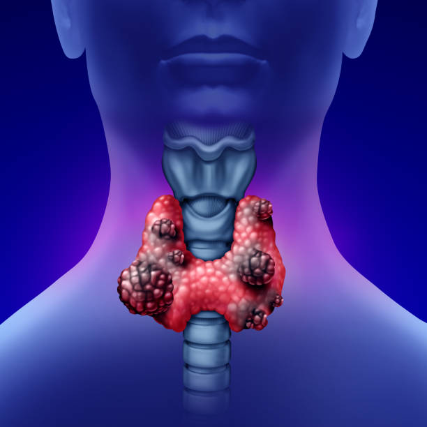 istock Cancer of the Thyroid 2150591354