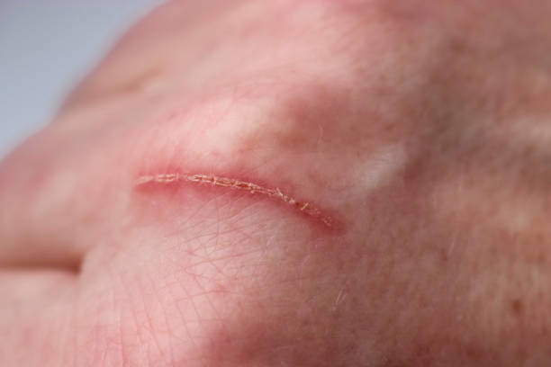 istock Hand scratched by a kitten. The dangers of cat scratch disease. Selective Focus 2150613222