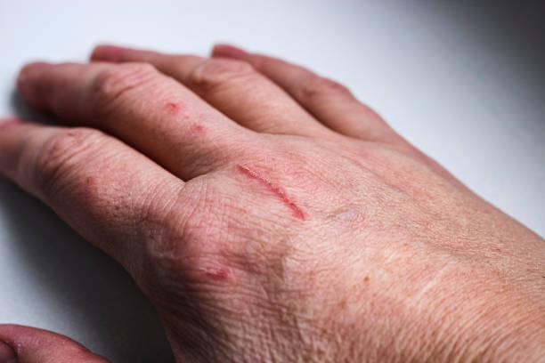 istock Hand scratched by a kitten. The dangers of cat scratch disease. Selective Focus 2150613232