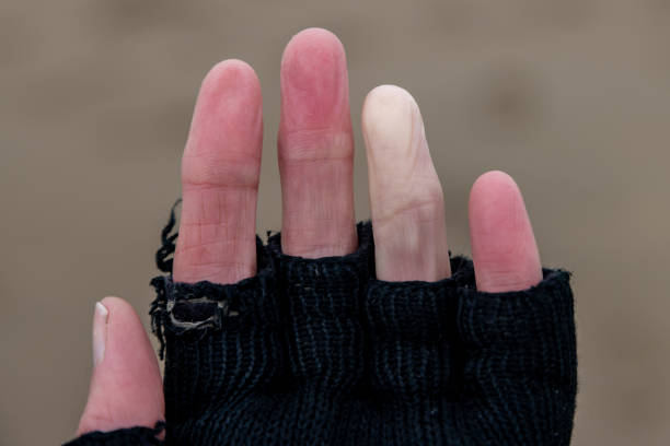 A close up of the fingers of a woman suffering from Raynaud's