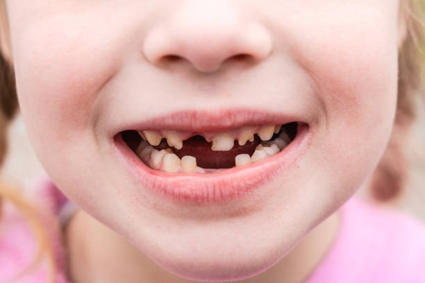 istock Kid shows off first missing tooth. Children without one tooth smiles 2150828316