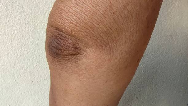 istock Black elbow and flabby skin. 2151066073