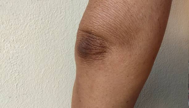 istock Black elbow and flabby skin. 2151066097