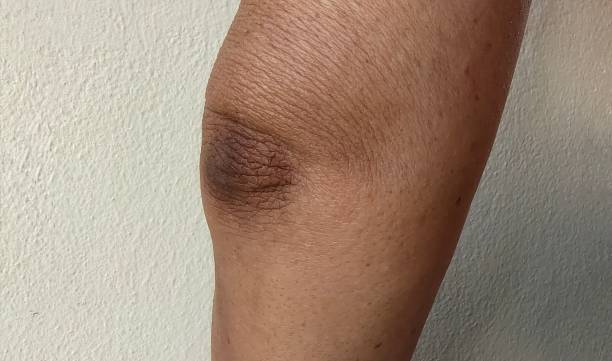 istock Black elbow and flabby skin. 2151066102