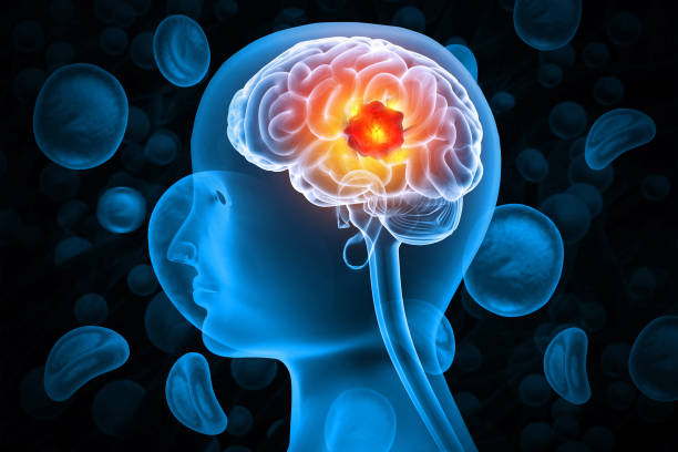 istock Brain tumor or barin cancer. 3d illustration 2151076805