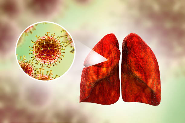 istock Virus attacking the human lungs. Lung disease. Viral infection. 3d illustration 2151077449