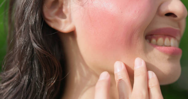 istock asian young girl sunburn face 2151090129