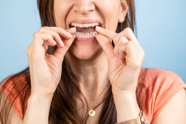 istock A woman puts braces in her mouth. 2151161376