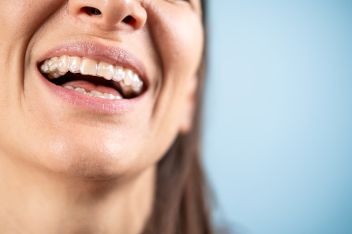 Invisible aligners for dental correction inserted, close up on a smile.