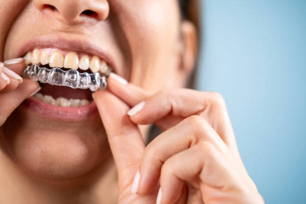istock A woman puts braces in her mouth. 2151161405