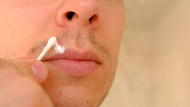 istock Man with herpes on lips against light grey background. Cold sore on a man lips. Sore virus concept. Man touch sore by cotton swab and use cream for treatment and therapy sore. Man spread white cream on a sore on his lip by cotton swab 2151185937