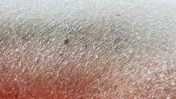 Eczema Dry Skin